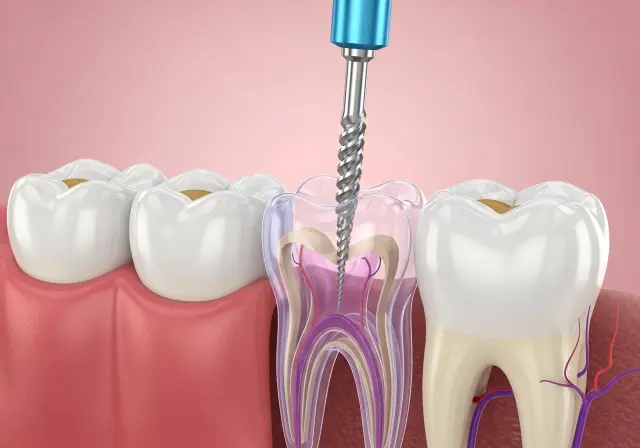 Root Canal Tedavisi Dental Pulp Cleaning